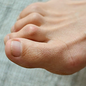 Hammertoe Banner