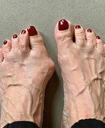 Bunion Surgery Miami Banner