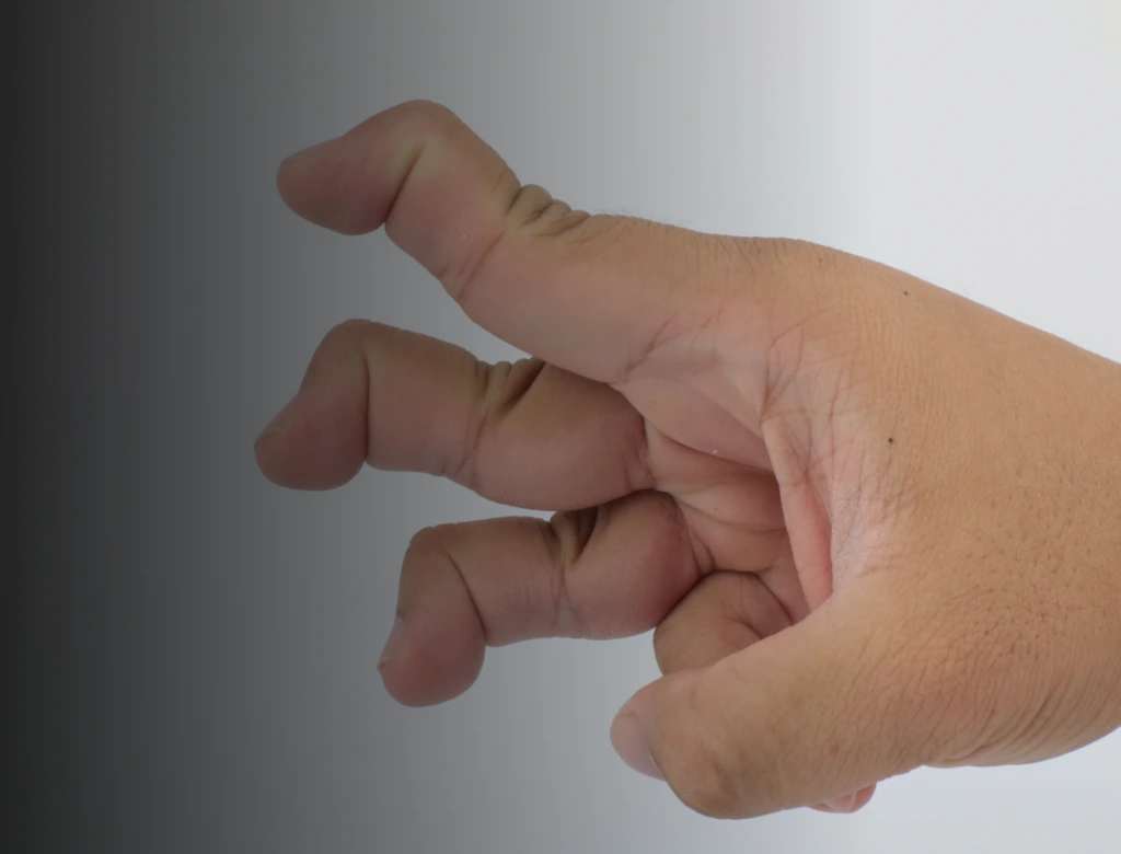 Swan Neck Deformity Banner