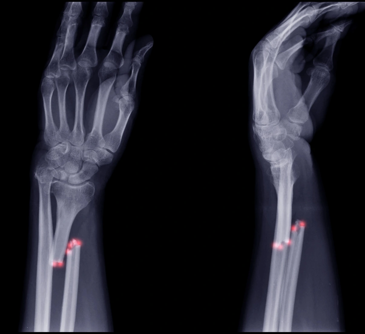 Ulna Fractures Banner