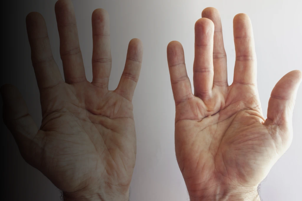 Dupuytren's Contracture Banner