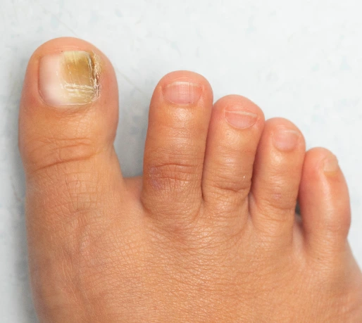 What Is Toenail Fungus? Banner