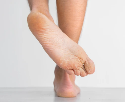 About Athlete’s Foot Banner