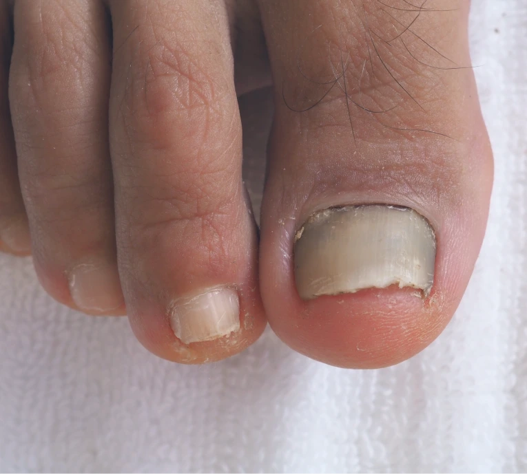 What Is an Ingrown Toenail? Banner