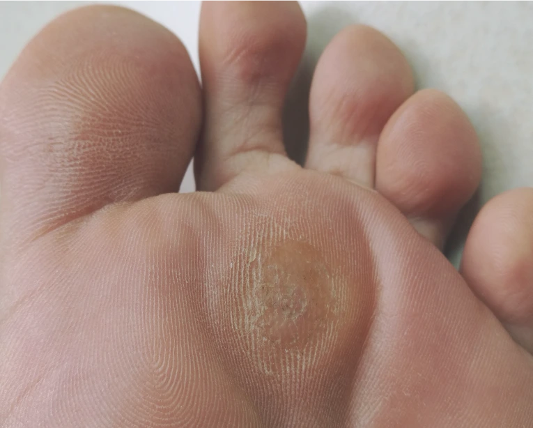 Recovery After Plantar Wart Treatment Banner