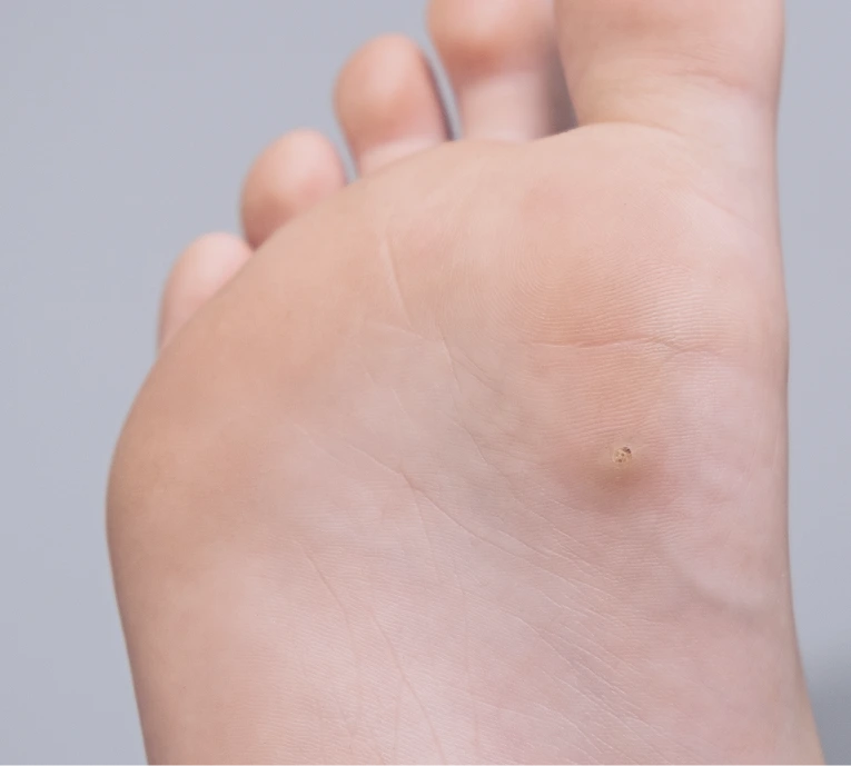 What Is Plantar Warts? Banner