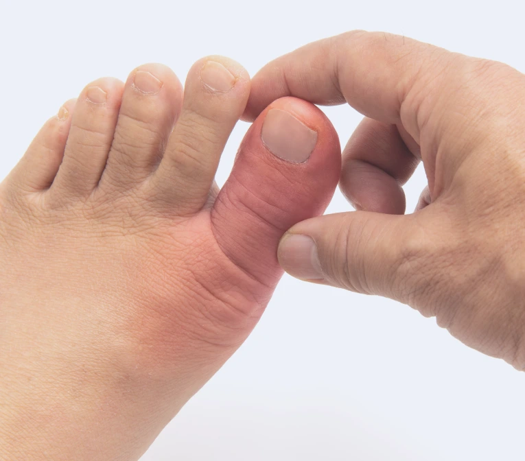 How Long Does Toe Pain Relief Miami Recovery Usually Take? Banner