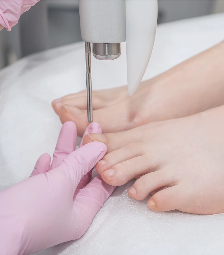 Recovery After Laser Treatment for Nail Fungus in Miami Banner