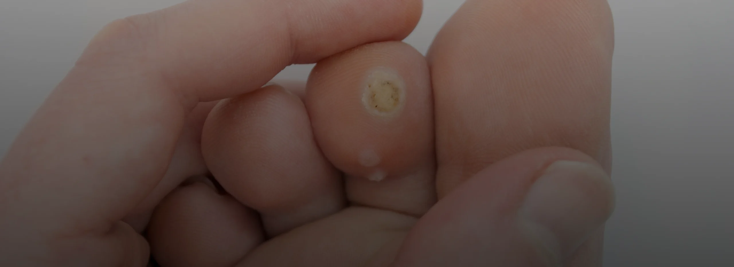 Wart Removal Miami, FL Banner