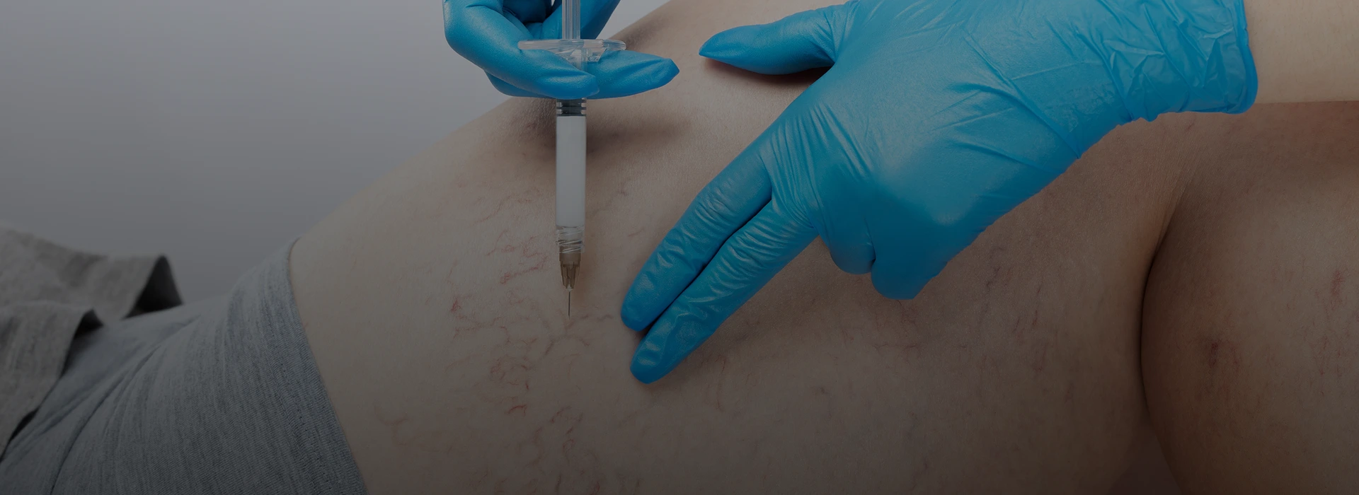 Sclerotherapy in Miami, FL Bg