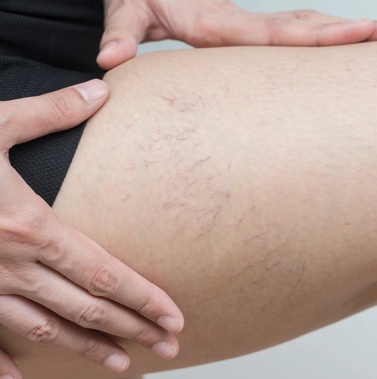 Sclerotherapy in Miami, Florida Banner