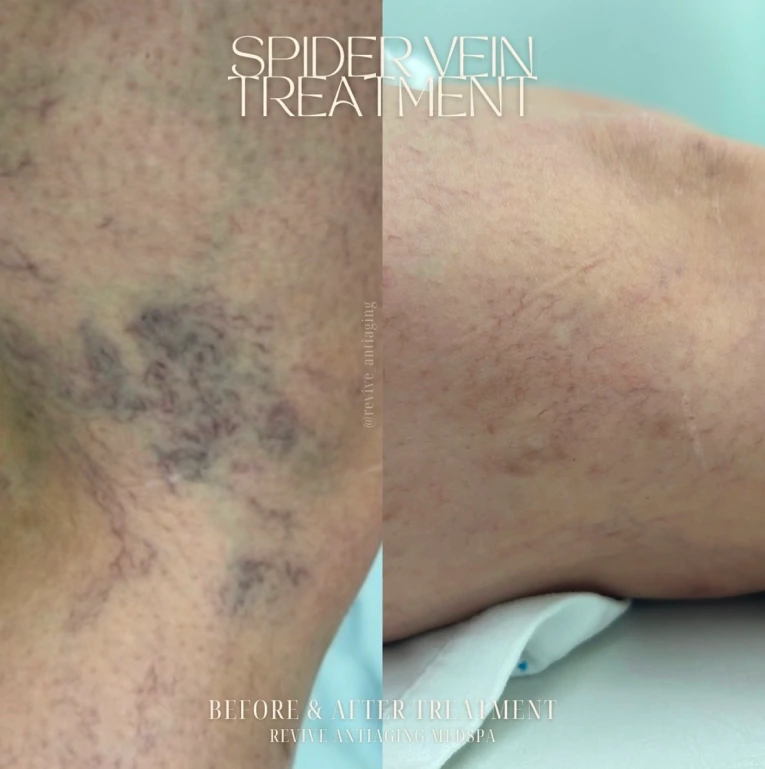 Spider Veins Removal in Miami, FL Banner
