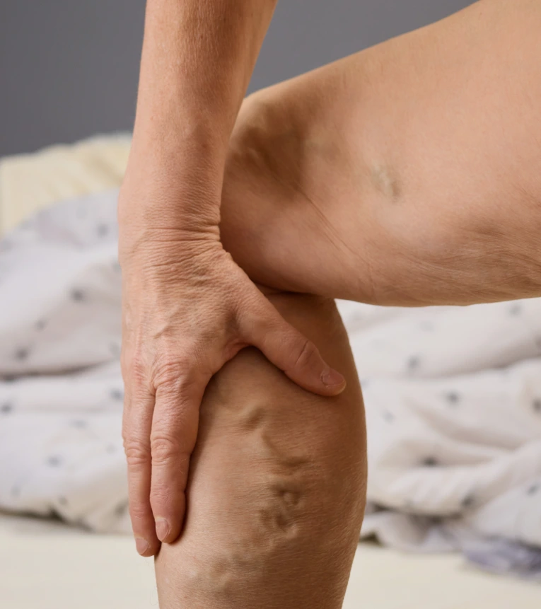 Varicose Veins Care in Miami, FL Banner