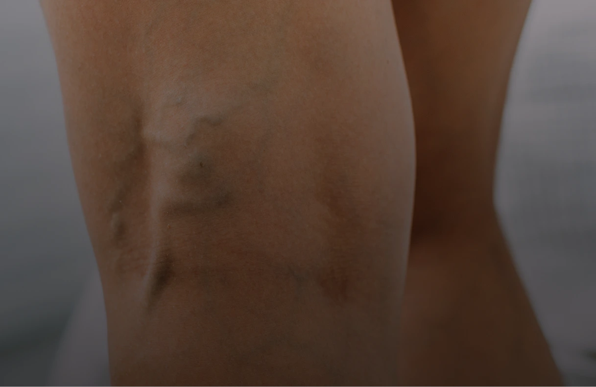 Varicose Veins Treatment in Miami, FL Banner