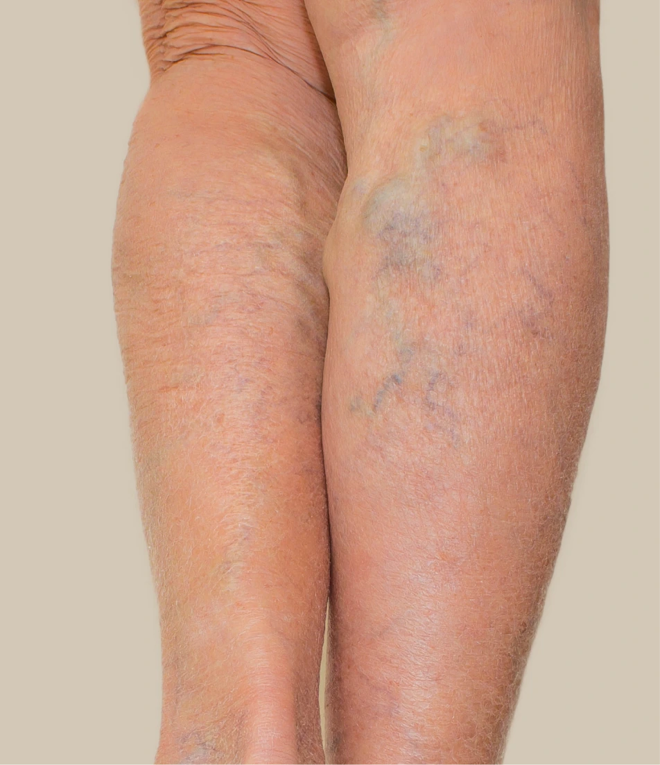 Varicose Veins Treatment in Miami, Florida Banner